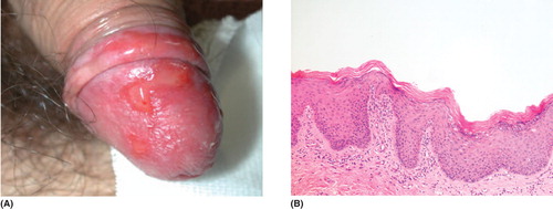 Figure 1. (A) Clinical features of the intraepithelial carcinoma at the onset. (B) Histological features of the intraepithelial carcinoma at the onset (hematoxylin-eosin).