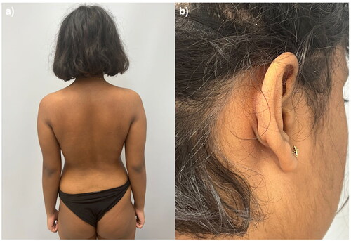 Figure 2. Complete skin clearance after 8 weeks (a, b).
