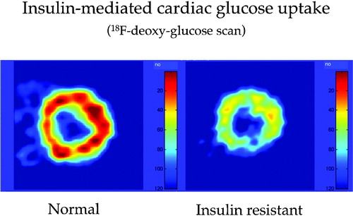 Figure 1. Myocardial muscle is insulin‐sensitive. Whereas free fatty acids (FFA) represent the dominant fuel for cardiac muscle in the fasting state, an increase in circulating insulin concentrations inhibits lipolysis, thereby restraining FFA availability and promoting glucose uptake. By using 18F‐deoxyglucose (FDG), an analog of glucose (which is transported and phosphorylated in the same manner as D‐glucose but not further metabolized) labelled with a short‐lived radioactive isotope of fluorine (18F), positron‐emission tomography (PET) detects a signal that is proportional to the rate of myocardial glucose uptake. The figure shows FDG images of human heart muscle during a euglycaemic insulin clamp. On the left hand is a cross‐sectional scan of the left ventricular wall of a normal subject, on the right hand that of an insulin resistant patient with type 2 diabetes, both taken during a euglycaemic hyperinsulinaemic (1 mU.min−1. kg−1) clamp. The colour‐coded tracer uptake intensity indicates diffuse myocardial insulin resistance in the diabetic patient.