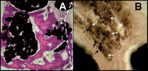 Figure 3. A. Osteoconduction of titanium particles with bone-surface contact (HE staining). B. Acid phosphatase staining (400×) with titanium microparticles (black arrows) engulfed by macrophages (solid white arrows).