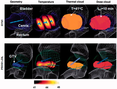 Figure 4. Patient-specific thermal models employed for optimisation and planning of hyperthermia treatments for cervical (top row) and prostate tumours where heating applicators with multiple transducer elements were deployed by endoluminal (cervix) and interstitial (prostate) placement. Case geometries and FEM meshes were constructed from CT scans which were segmented to delineate critical organs, tumour targets and applicator positions. Reproduced from Chen X et al. (Optimisation-based thermal treatment planning for catheter-based ultrasound hyperthermia. Int J Hyperthermia 2010;26:39–55).