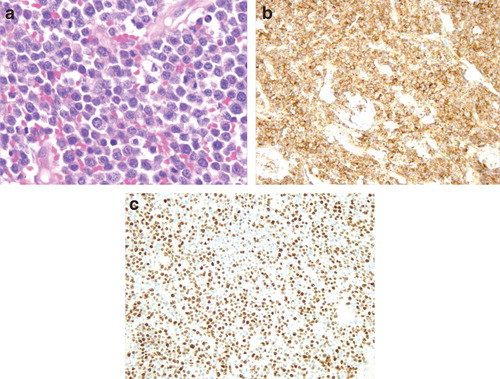 Figure 2. (a) Immature plasma cells, with large eccentric nuclei and scattered mitosis (H&E ×40). (b) Intense staining of CD138 (×10). (c) Positive staining for Ki67 (high proliferation index >80%) (×10).