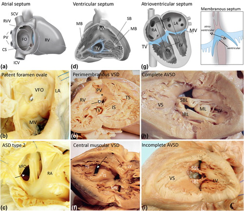 Figure 4. The cardiac septa in the adult and morphology of septal defects. a: Normal atrial septum after birth, right lateral view. A fenestration has been drawn to allow visualization of the atrial septum. The foramen ovale is closed and can be recognized as the fossa ovalis (FO). b: Patent foramen ovale, as seen from the left atrium (LA). The valvula foraminis ovalis (VFO, derived from the embryological septum primum) is competent but has not fused with the septum secundum, thus allowing the probe to be inserted from the right side. c: Atrial septal defect type 2, as viewed from the right atrium (RA). The valvula foraminus ovalis (VFO, septum primum) is deficient, thus leaving a septum defect (arrow). d: Normal ventricular septum, as viewed from the right side. The different septal components can be recognized and include the ventricular inlet septum (IS), below the tricuspid orifice, and the anterior and apical trabeculated parts (TS). The septal band (SB) and moderator band (MB, which has been cut in order to open the RV) are indicated. e: Perimembranous ventricular septal defect (arrow), as seen from the right ventricle (RV). f: Central muscular ventricular septal defect (arrow), as seen from the left ventricle (LV). The defect is classically situated at the border between two septal components, i.e. the inlet septum (IS) and the trabeculated septum (TS). g: Normal atrioventricular septum. Note the differential insertion of the tricuspid valve (TV) and mitral valve (MV), resulting in the length of the AV septum between the right atrium and left ventricle. The membranous septum consists of an atrioventricular (double arrow) and interventricular part. h: Complete AVSD. The anterior bridging leaflet (ABL) and inferior bridging leaflet (IBL) are not attached to the atrial septum (not shown) and ventricular septum (VS), allowing shunting at both the atrial and ventricular level. i: Incomplete AVSD. Both the superior bridging leaflet (SBL) and inferior bridging leaflet (IBL) are attached to the ventricular septum (VS), therefore shunting can only occur at the atrial level (not shown). (CS = coronary sinus; ICV = inferior caval vein; ML = mural leaflet; MV = mitral valve; PV = pulmonary veins; PuV = pulmonary valve; RVV = right venous valve; SCV = superior caval vein; VS = ventricular septum).