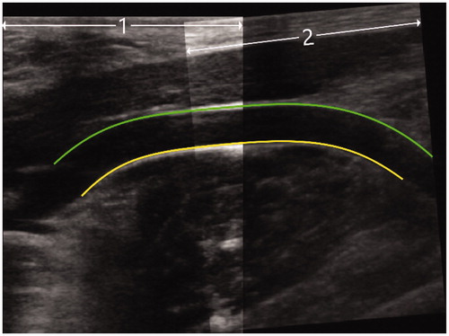 Figure 3. Example of diagnostic ultrasound image, as used for the calculation of the mean diameter of the target vessel. Two separate ultrasound images were fused (1 and 2), after which the diameter was determined (between the green and yellow lines).