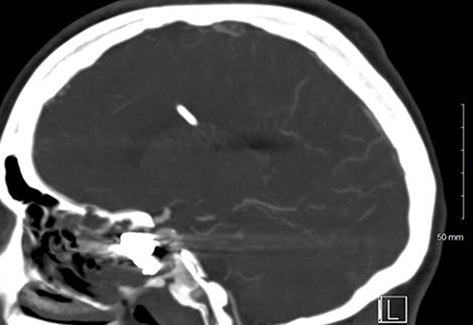 Figure 14 Sagittal view of the head CT showing persistent occlusion of the pseudoaneurysm and internal carotid artery patency.