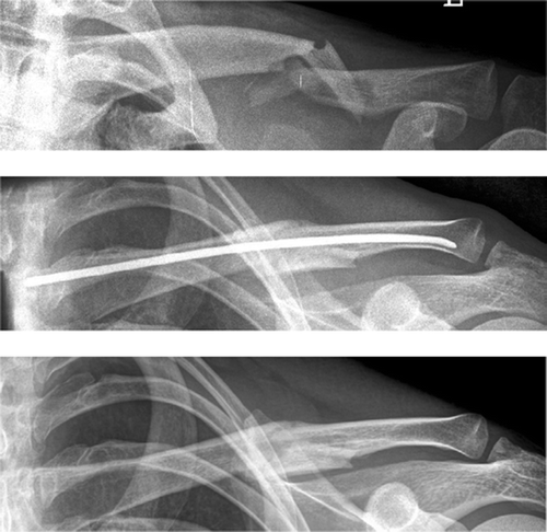 Figure 3. Displaced midclavicular fracture in a 27-year-old man (upper panel). Correct healing after elastic stable intramedullar nailing (middle panel) and radiograph after implant removal (lower panel).