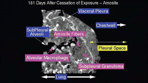 Figure 16.  View of the pleural space from an animal exposed to amosite asbestos at 181 days postexposure. Amosite fibers are seen in a subpleural granuloma with numerous alveolar macrophages in the subpleural alveoli.