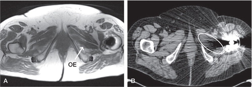 Figure 3. Patient 13. All muscles visualized on MARS MRI scan (A), but obturator externus (OE) (labelled on left and circled on right) could not be seen on the equivalent CT scan (B) despite being viewed in a soft tissue window.