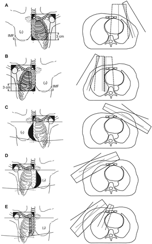 Figure 1. Field arrangements in the five radiotherapy techniques. Left: A: Left-sided two field arrangement in post-mastectomy patients (PM Left), B: Right-sided three field arrangement in post-mastectomy patients (PM Right), C: Left-sided standard tangents in post-lumpectomy patients (PL Left), D: Right-sided wide tangents in post-lumpectomy patients (PL Right T) and E: Right-sided electron field combined with tangential fields in post-lumpectomy patients (PL Right E + T). Black: Shielded areas. Light grey: Photon fields. Dark grey: Electron fields. Right: Axial slices: Dashed Lines: Electron field borders, Solid lines: Photon field borders. Dotted lines: Field axis.