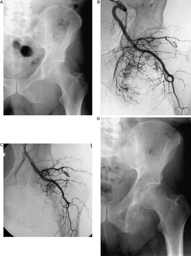 Figure 2.  This example of a pelvic metastasis (left inferior pubic ramus) was treated with 250–355 micron PVA only. The patient experienced complete resolution of his pain for 9 months. A) Pre-procedure pelvic radiograph with destruction of the left inferior pubic ramus. B) Selective left internal iliac artery angiogram demonstrating the hypervascular renal cell carcinoma metastasis. C) Post-embolization angiogram showing elimination of the hypervascularity in the region of the inferior pubic ramus. D) Follow-up post-embolization pelvic radiograph showing sclerosis of the treated metastasis. This finding is unusual, but has been reported. (19).