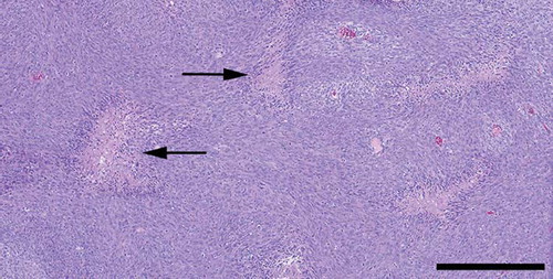 Figure 3. There were numerous necroses throughout the tumour (Haematoxylin-eosin. Bar 500 μm).
