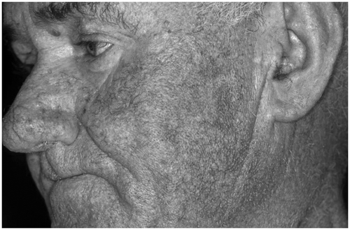 Figure 5. Topical overdosage of corticosteroids. Following long-term application, development of telangiectasias and a rosacea-like dermatitis may occur, particularly on the face.