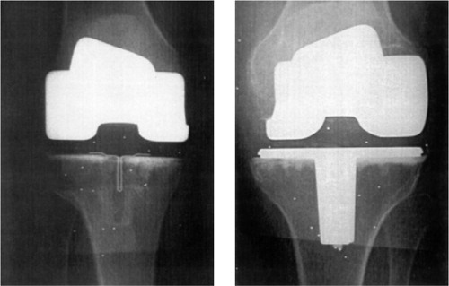 Figure 2. Standard anterior postoperative radiographs of the a) all-polyethylene, horizontally cemented (APHC), and b) metal-backed, horizontally cemented (MBHC) tibial components.