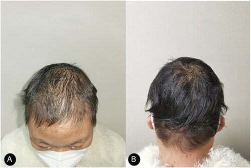 Figure 3. (A, B). Visible regrowth of terminal hairs on her scalp after six-month abrocitinib treatment.