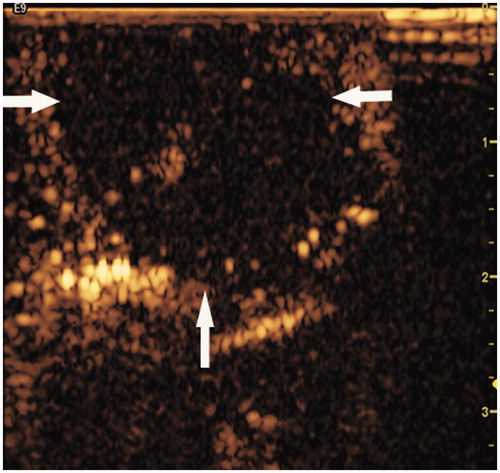 Figure 4. RF ablative zone detected by contrast-enhanced ultrasonography (CEUS). The representative image shows the ablative zone as a non-enhanced region (white arrow) during the post-procedure examination by CEUS. The ablative zone was located in the muscle abutting the skin (35 × 34 mm, 300 × 300 dpi).