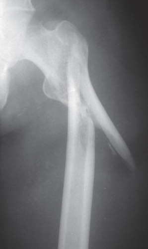 Figure 2. After 3 months on skeletal traction. Yet again, a lateral radiograph was not possible because of lack of resources. There was no obvious callus formation. There was some rounding of the sharp fragment ends and the displacement had increased.