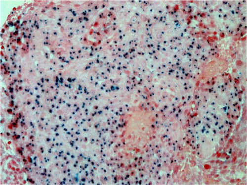 Figure 1. Human papillomavirus-16 positive tumor defined by punctate hybridization signals localized to the tumor cell nuclei.