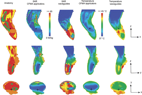 Figure 10. Cross sections of the simulated SAR and temperature distributions with CFMA and waveguide applicators. In both cases, the water bath temperature was 42°C and the absorbed power 200 W in tissue and water bath. The colours red, yellow and green in the anatomy represent muscle, fat and bony tissue, respectively and tumour tissue is orange. The small black cross hair indicates the location of the cross sections.