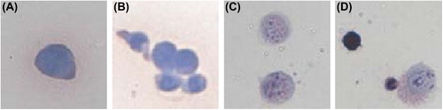 Figure 2. Recognition and indentation of CTCs. (A) and (B) original cell A549. (C) A549 that reacted with immunomagnetic antibodies. (D) cell A549 and residual white cell after immunomagnetic enrichment and separation.