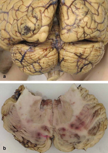 Figure 2. Macroscopy of the central nervous system with hemorrhages. (a) Dorsal view of the cerebrum and cerebellum with multiple, petechial and somewhat larger, partly confluent hemorrhages in cerebral cortex of occipital lobes. (b) Cerebellar hemispheres on cut surface with multiple, petechial and somewhat larger, partly confluent hemorrhages.
