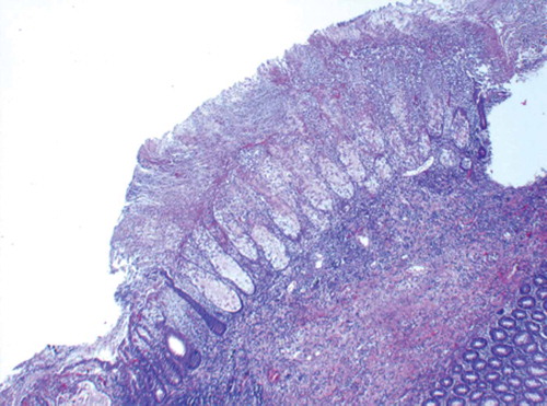 Figure 3. High-powered micrograph of hematoxylin and eosin stained colonic mucosa showing focal lesion of necrosis and eruptive mass of mucus, and cellular debris. Neutrophils are attached to the surface. There are varying degrees of ischemic necrosis. Acute and chronic inflammation as well as edema is seen in lamina propria and submucosa.