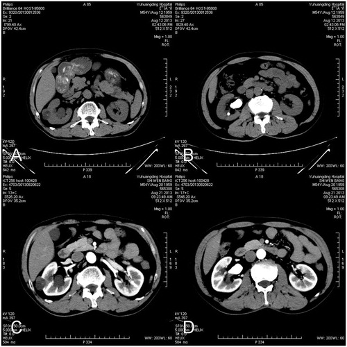 Figure 1. Non-contrast CT scan images of a patient with homolateral renal tumor (A) and renal calculus (B); and enhanced CT scan (C and D) of the same location. Tailed-arrows showed renal tumor and arrowheads indicated renal calculi.