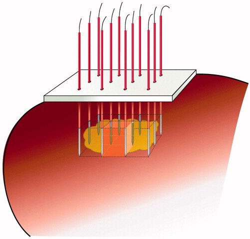 Figure 1. Matrix radiofrequency ablation. The whole tumour volume is contained within a cage of x × y parallel electrodes. The volume within this cage is the sum of (x − 1) × (y − 1) square blocks, each determined by 2 × 2 electrodes. One cluster of 2 × 2 electrodes is the smallest functional unit of such a matrix of electrodes. Ablation of the whole volume is obtained by activation of the 2 × 2 electrodes around the first block, then rapidly switching to the electrodes around the second block, and so on until impedance rise at all blocks prevents further current flow.