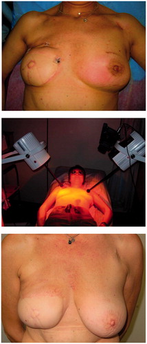 Figure 4. Inflammatory recurrent breast cancer in a 51-years old patient. Former conservative therapy for triple negative breast cancer consisting in tumourectomy, sentinel lymphadenectomy, adjuvant chemotherapy and radiotherapy with 50 Gy whole breast and boost up to 60 Gy. First recurrence treated with salvage surgery, chemotherapy followed by breast reconstruction. Top: Situation before start of re-RT and wIRA-HT (21.6.2011, patient in treatment position). Several biopsies on both breasts confirmed the inflammatory recurrence. Middle: First thermographically controlled wIRA-HT of both chest wall regions. Bottom: 4 years after completion of hypofractionated re-RT with 5 × 4 Gy and wIRA-HT (NED, 21.9.2015, patient in sitting position). Teleangiectasias are evident especially in the décolleté and the former irradiated region