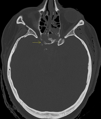 Figure 5 Axial view of the head CT. (Yellow arrow: right-sided lateral sphenoid wall fracture due to force of penetrating trauma).