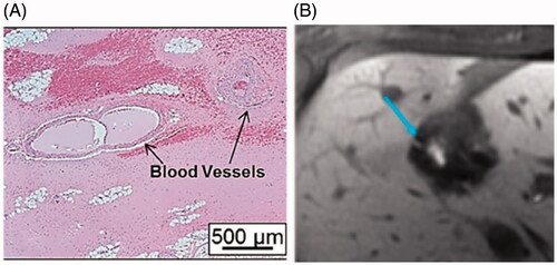 Figure 3. (A) Large blood vessels remain intact and surrounded by acellular debris within the in vivo porcine liver treated by histotripsy (reproduced based on an image from ref [Citation37]. (B) Contrast-enhanced MR image showing a patent bile duct (blue arrow) within the dark histotripsy treatment zone (reproduced based on an image from ref [Citation84].
