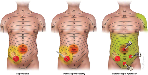 Figure 3 Pain type, intensity and distribution in Appendicitis patients. Acute appendicitis (top left) mainly produces well-localized sharp pain (red color overlay) in the left lower abdomen, with referred pain to the umbilicus (yellow color overlay), which is more poorly localized. Open appendectomy (top middle) produces sharp incisional pain in addition to pain associated with acute appendicitis (red overlay). Further pain occurs during blunt dissection of deeper muscles and tissues, and visceral pain occurs during peritoneal incision and appendix manipulation. Laparoscopic appendectomy (top right) produces sharp incisional pain at the sites of trocar insertion in addition to the pre-existing pain of acute appendicitis (red overlay). After carbon dioxide insufflation, diffuse stretching of the abdomen and peritoneum results in diffuse and poorly localized discomfort (green overlay). There is also referred pain in the shoulder due to irritation of the diaphragm (green overlay). ©2023 Body Scientific International, LLC.
