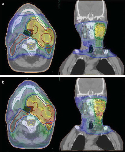 Figure 3. Treatment plans for a T1N2cM0 floor of mouth tumour. The primary PTV was prescribed to a dose of 68 CGy and the nodes to 54 CGy Figure 3a shows the dose distribution obtained with IMPT and Figure 3b the dose distribution with IMRT.