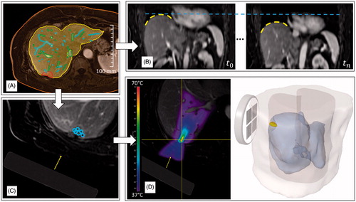 Figure 4. Workflow-steps within the software demonstrator for an example patient case. Based on image segmentation methods the anatomical patient model is defined: (A) shows contours of the skin line, liver, portal and hepatic vein and the tumour. After the motion model adaption to the patient the motion can be assessed in a live preview: (B) shows two example motion states of the preview with superimposed dashed lines to highlight the difference of liver position. Afterwards an interactive treatment planning can be performed: (C) shows the virtual transducer placed in the image and the sonications currently planned. Based on the planning, the therapy outcome can be predicted using the numerical simulation: (D) hows the temperature distribution in 2D superimposed on the planning image and a 3D visualisation of the tissue damage.