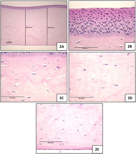 Figure 2. Positive control (100% ethanol), 10-min exposure, 120-min post-exposure. (A) Full thickness of the cornea which was appreciably thicker than the negative control treated corneas, magnification 42x (B) Epithelium, magnification 420x (C) Upper stroma showing hyperchromic staining i.e. coagulation in the zone directly below the anterior limiting lamina, stromal swelling, and the decrease in density of viable keratocytes, magnification 420x (D) Stroma near mid depth showing stromal swelling and keratocyte nuclear enlargement, magnification 420x (E) Endothelium (intact), magnification 420x.