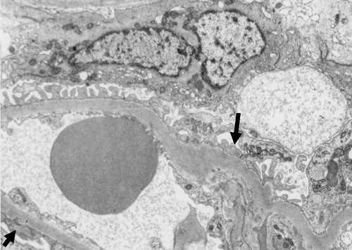Figure 2. Electron photomicrograph showing focal effacement of foot processes (arrows). No immune complex deposits are evident.