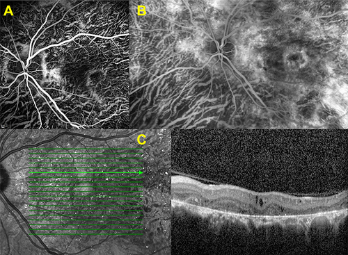 Figure 6 Associated macular edema. Left eye, early venous (A) and late composite venous (B) fluorescein angiographic images revealing the increasing macular hyperfluorescence. SD-OCT section showing the cystoid macular changes corresponding to macular edema (C).