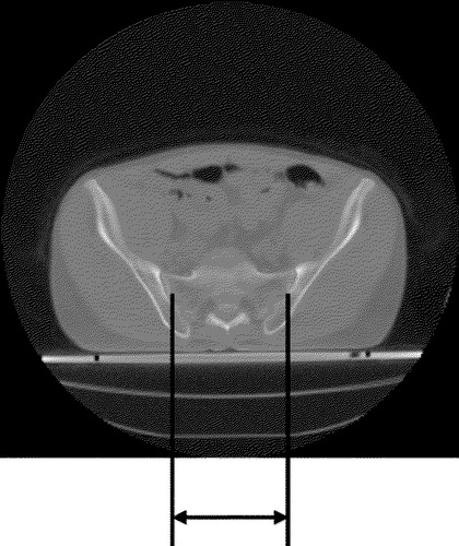 Figure 2. The CT scan of the sacral region for patient:treatment 6:1. Since the sacroiliac joint moves sagittally oblique the distance between the ventral and dorsal measurements differs. The mean of the ventral and dorsal measures was used when determining the width of the sacrum in order to correct for this difference.