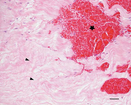 Figure 4. Microscopic longitudinal section (H&E stained) of injured tendon (A) characterized by acellular necrotic area (arrows) and hemorrhages (*). A refers to tendon ID (see Tables 1 and 2). Bar = 100 μm.