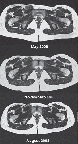 Figure 1. Fibromatosis of the right inguinal region. PLD 40 mg/m2 × 6 February 2006 to July 2006. Tumour shrinkage and symptomatic relief. Images: May 2006, November 2006, August 2008.