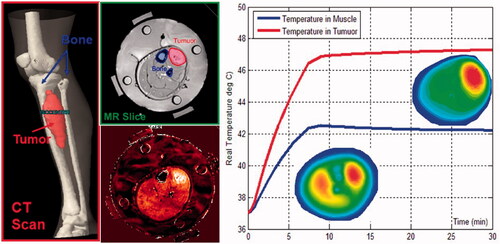 Figure 4. Combined use of segmentation, EM, and thermal solvers to generate initial temperature distributions in the pretreatment phase. During treatment, the MR temperature imaging (MRTI) provides feedback to empirically determine patient-specific parameters, e.g. perfusion. This information was used to steer the beam effectively to the target tumour on the right side of the leg and away from the muscle at the left of the bone [Citation67,Citation155].
