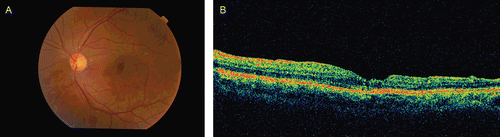 FIGURE 4  (a) Fundus picture of the left eye 1 year postoperatively. (b) OCT of the left eye 1 year postoperatively.