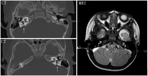Figure 2. High-resolution computed tomography (CT) and magnetic resonance imaging (MRI) of the temporal bones in patient III-2. Bilateral enlargement of the vestibular aqueduct and endolymphatic sac (arrows) is evident.