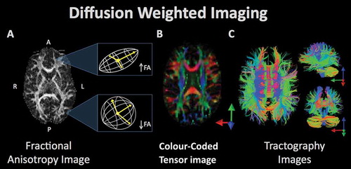 Figure 4. Diffusion weighted imaging refers to a set of magnetic resonance imaging procedures that exploit water diffusion in tissue as the basis of image contrast. Diffusion imaging measures various properties of the behavior of water in the brain such as fractional anisotropy (FA), radial diffusivity, etc. These measurements can be used to quantify various aspects of tissue microstructure, which can be compared between groups, as well as used in visualization of the anatomy of prominent white matter fascicles and other anatomical properties. (A) The white matter tracts of a single subject’s brain, reconstructed from the FA values where high FA represents regions of strict, directed water diffusion (along the borders of white matter bundles) and low FA indicates regions with isotropic water diffusion. (B) The white matter tracts from FA values are color-coded to indicate the direction of water diffusion in order to illustrate the arrangement and organization of bundles of white matter. (C) Visualization of diffusion tensor imaging (DTI) data in the axial (left), sagittal (top right), and coronal plane (bottom right). Fiber bundle directionality is indicated by color (red = right to left/left to right (e.g. corpus callosum), green = posterior to anterior/anterior to posterior (e.g. cingulum bundle), blue = inferior to superior/superior to inferior (e.g. corticospinal tracts)).