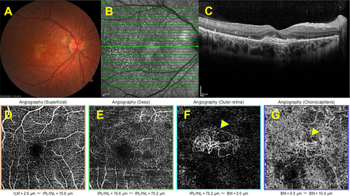 Figure 5 Associated macular neovascularization. Right eye, Color fundus image showing the hypopigmented looking well-demarcated lesion at the macula (A). The horizontal SD-OCT section demonstrating the macular neovascularization (B,C). Optical coherence tomography angiographic slabs demonstrating the presence of quiescent choroidal neovascularization (yellow arrows) (D–G).