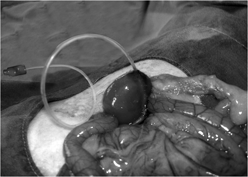 Figure 1.  The appearance of the catheter in the pelviureteral region.