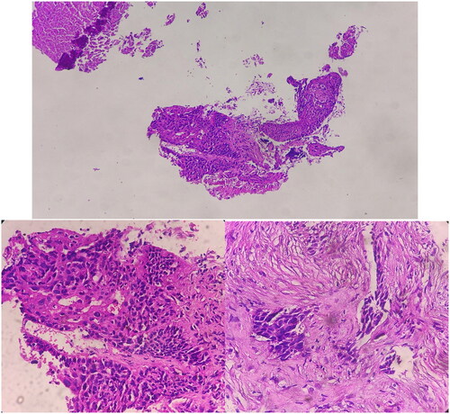 Figure 4. Sections show stratified squamous mucosa and underlying fibrotic tissue involved by malignant neoplastic lesion composed of sheets and nests of atypical pleomorphic cells with high nuclear to cytoplasmic ratio and acidophilic cytoplasm with rare mitosis; foci of necrosis and hemorrhage.