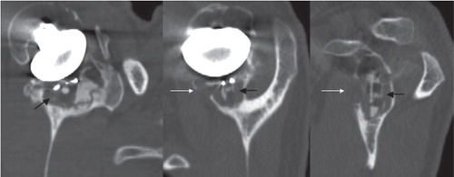 Figure 6. Cancellous bone osteolysis (indicated by the black arrows) and cortical bone osteolysis (indicated by the white arrows) visualized using the described protocol, in the sagittal plane of the glenoid implant (left), in the axial plane of the middle part of the implant (middle), in the coronal plane of the implant, passing through the keel hole (right).