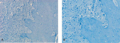 Figure 2. Low-power (A) and high-power (B) photomicrographs showing absence of LYVE-1 staining in the femoral arthroplasty membrane, which contains numerous plump (wear particle-containing) macrophages and surrounding compact cortical bone. (Immunoperoxidase; 100× and 200× magnification).