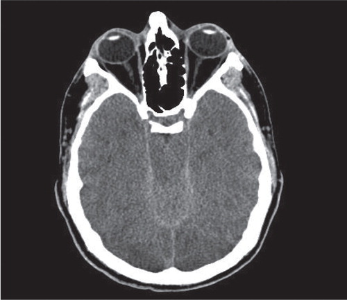 Figure 2. Head CT (axial view) showing cerebral edema and tonsillar herniation.