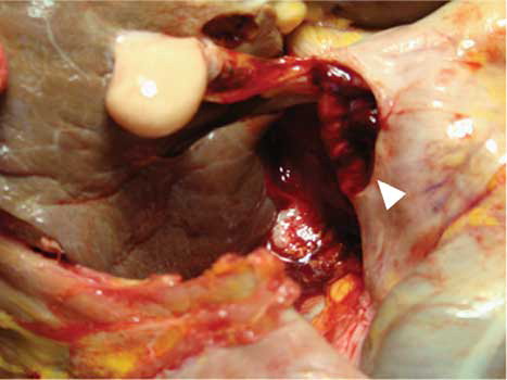 Figure 4. Autopsy revealed perforation of duodenum (white arrow).